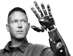 best-myoelectric-prosthesis-hand-manufacturer