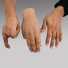 affordable-prosthetic-leg-nerul