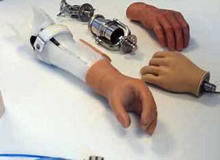 upper-limb-prosthetic-artificial-hand-dadar