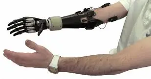 upper-limb-prosthetic-artificial-hand-mulund